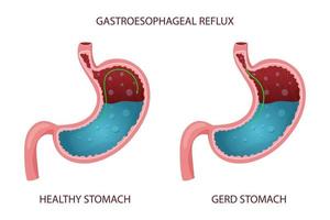 gesunder magen und gastroösophageale refluxkrankheit illustration vektor