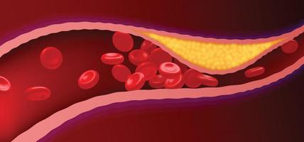 Arterien mit verstopftem Fett, das Blutgerinnsel verursacht. vektor