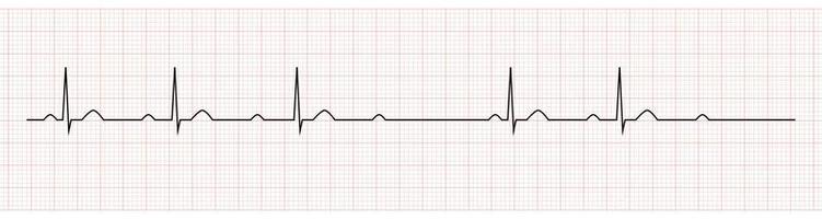 ekg som visar andra grad AV blockera mobitz jag vektor