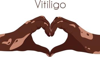 zwei Hände mit Vitiligo Patches im das gestalten von ein Herz. selbst Liebe Konzept. Welt Vitiligo Tag. ich Liebe meine Haut. braun Haut mit ein Patch von Vitiligo. Haut Krankheiten. selbst Pflege vektor