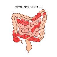 Crohn Krankheit Innereien Medizin Anatomie Vektor Illustration