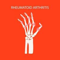 Arthritis Hand rheumatoide Medizin Bildung Vektor planen