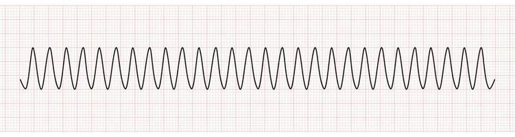 ekg Monitor zeigen ventrikulär Tachykardie oder vt vektor