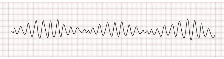 ekg övervaka som visar polymorf ventrikel takykardi eller vt torsades de pointes vektor