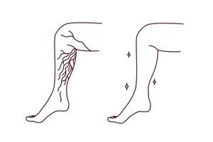 närbild av ohälsosam och friska ben med åderbråck ådror. patient lida från åderbråck. sjukvård och medicin. vektor illustration.