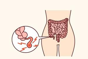 närbild av mänsklig kropp med inflammerad bilaga. person lida från appendicit behöver kirurgi. vektor illustration.