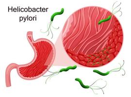 Helicobacter Pylori im Bauch epithelial Zellen unter Vergrößerung. Vektor Illustration, Karikatur Stil