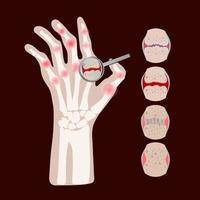 rheumatoide Krankheit Arthritis Medizin Bildung Vektor planen