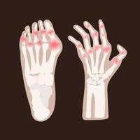 hand ben artrit reumatoid medicin utbildning vektor schema