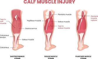 Kalb Muskel Verletzung Infografik
