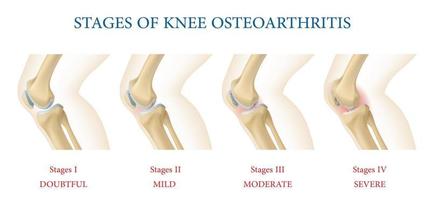 knä gemensam osteoartrit stadier infographics vektor