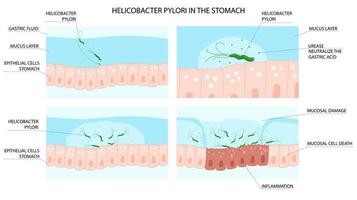 Helicobacter Pylori Infektion Prozess im Bauch mit Entzündung Entwicklung vektor
