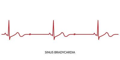 EKG Herzschlag Linie. Elektrokardiogramm Vektor Illustration. Sinus Bradykardie