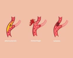 typer av mänskliga hjärnan stroke koncept illustration vektor