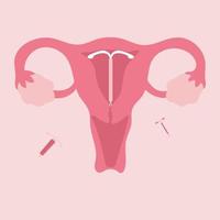 platt illustration av preventivmedel iud vektor