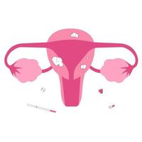 Uterusmyom. Probleme mit weiblichen Fortpflanzungsorganen. Unfruchtbarkeit verursacht. vektor