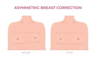 asymmetrisch Brust Korrektur Vor und nach Plastik Chirurgie Vorderseite Aussicht vektor