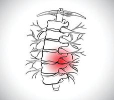 Bandscheibenvorfall, kann starke Rückenschmerzen verursachen, die zu Lähmungen führen können vektor