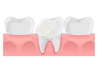 bruten tand. knäckt tand i platt stil. tänder och gummi anatomi. dental hälsa. vektor illustration isolerat på vit.