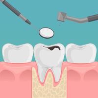 tänder med förfall i gummi. tand med karies hål behandling begrepp. tandläkarens verktyg. platt tandvård vektor illustration.