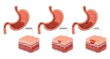 Bauch Erosion und Geschwür Illustration vektor