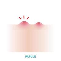 papule acne vektor på vit bakgrund. bildning av inflammatorisk acne, papule, små, Uppfostrad, fast finne eller svullnad, formning på de hud och inflammerad. platt design vektor acne illustration.