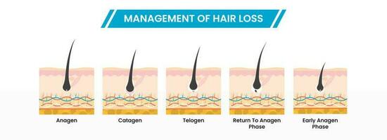 förvaltning av hår förlust eller tillväxt faser infographic schema ikoner i platt stil. vektor