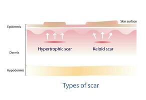 Art von Keloid Narbe und hypertrophe Narbe auf Haut Oberfläche. Narben sind verursacht durch Wunden Das erreichen das Dermis Schicht. vektor