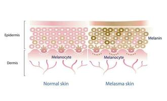 vanligt hud lager och melasma hud lager vektor, melanocyt, melanin, melanogenes vektor på vit bakgrund.