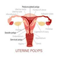 typer av uterin polyper. sjukdomar av de kvinna reproduktiv systemet. gynekologi. medicinsk begrepp. infographic baner. vektor