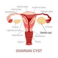 äggstockar cysta. sjukdomar av de kvinna reproduktiv systemet. gynekologi. medicinsk begrepp. infographic baner. vektor