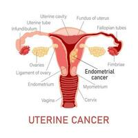 uterin cancer. sjukdomar av de kvinna reproduktiv systemet. gynekologi. medicinsk begrepp. infographic baner. vektor