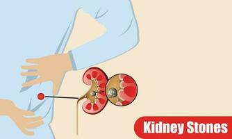 Mensch Niere Steine, Niere innen, Niere System, Bohne Form, Vektor Illustration.
