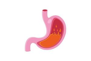 medizinisch Illustration von Pyrose Bauch isoliert. Feuer Störung Innerhalb Magen. vektor