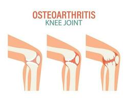 rheumatoide Arthritis. Arthrose von das Knie Gelenke. medizinisch Konzept. Infografik Poster, Banner, Vektor