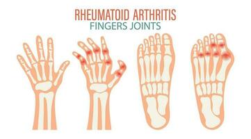 reumatoid artrit. osteoartrit av de lederna av de fingrar och tår. medicinsk begrepp. infographic affisch, baner, vektor