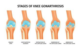 Gonarthrose realistisch Infografiken vektor