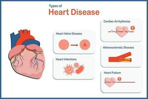 vektor illustration begrepp för medicin typ av hjärta sjukdom, aterosklerotisk sjukdom, hjärt arytmier, hjärta ventil sjukdom, hjärta infektioner, hjärta misslyckande.platt stil