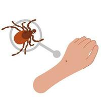 das Mensch Hand mit das Tick beissen. Tick beißen hand.tick beissen. Gesundheitswesen Illustration. vektor