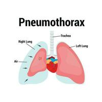 Symptome von Pneumothorax Lunge Vektor