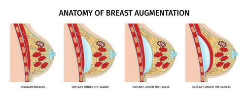 bröst anatomi implantat uppsättning vektor