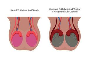 Illustration Vergleich von normal Nebenhoden und Hoden, und abnormal Nebenhoden und Hoden. Nebenhodenentzündung Orchitis. eps 10 vektor