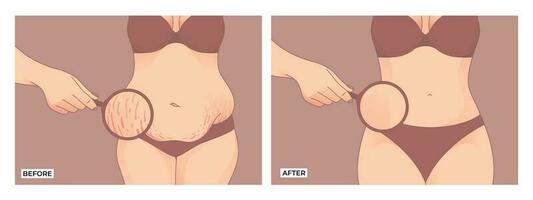 Bauch fett. Vor und nach Gewicht Verlust, Frau Körper gestalten Transformation, Fett zu fit. vektor