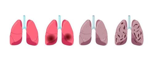 lungsjukdomar progression uppsättning. hälsosam inflammation lunginflammation och tuberkulos virusinfektion. mänskligt andningsorgan inre organvirus slog. medicinsk anatomi skada vektor eps illusrtation