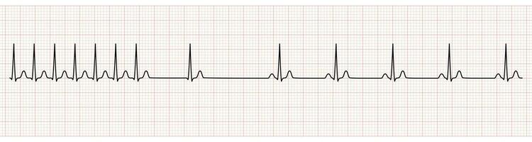 ekg övervaka som visar supraventrikulära takykardi förändra till sinus rytm efter adenosin injektion vektor