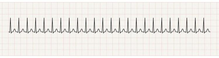 ekg övervaka som visar supraventrikulära takykardi vektor