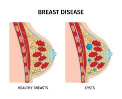 bröst sjukdom anatomi sammansättning vektor