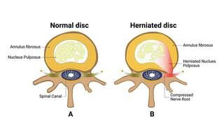 normal Rabatt und herniert Rabatt Design Vektor Illustration