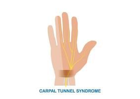 vektor illustration av karpal tunnel syndrom