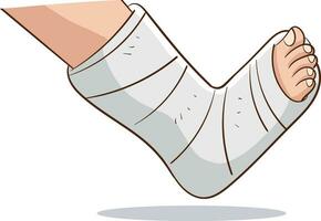 Vektor Illustration von orthopädisch Gips oder Glasfaser gießen, gebrochen Bein, Knochen Fraktur